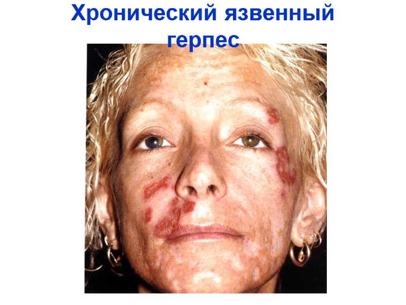 Хронический язвенный герпес